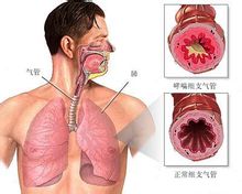 Äge astmaatiline bronhiit
